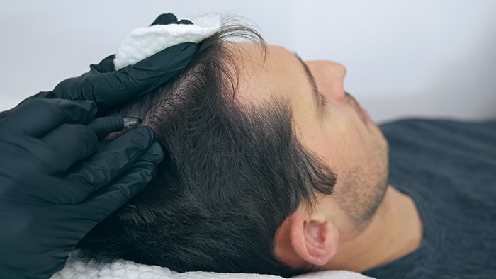 زراعة الشعر في السعودية