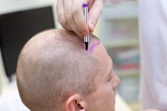 زراعة الشعر في الرياض