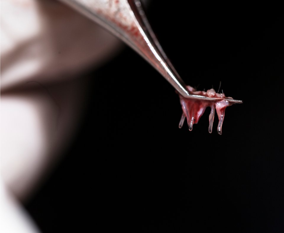 زراعة الشعر